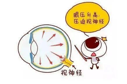 青光眼怎么预防呢