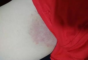 阴囊湿疹是怎么引起的